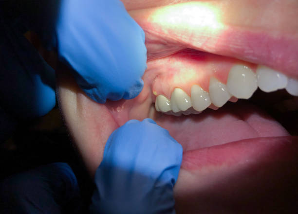 Best Emergency Broken Tooth Repair in Nashvle, IL